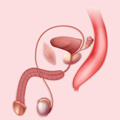 Cancer Des Testicules